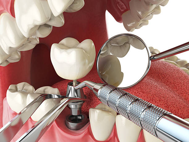 Best Emergency Wisdom Teeth Removal in Lake Wazeecha, WI